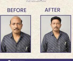 Ultimo Capelli Hair wigs, Hair Patches and Replacement service Bhubaneswar